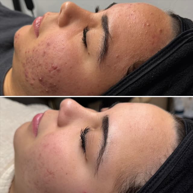 The Acne Clear Package at Navarro Skin in Sacramento, CA